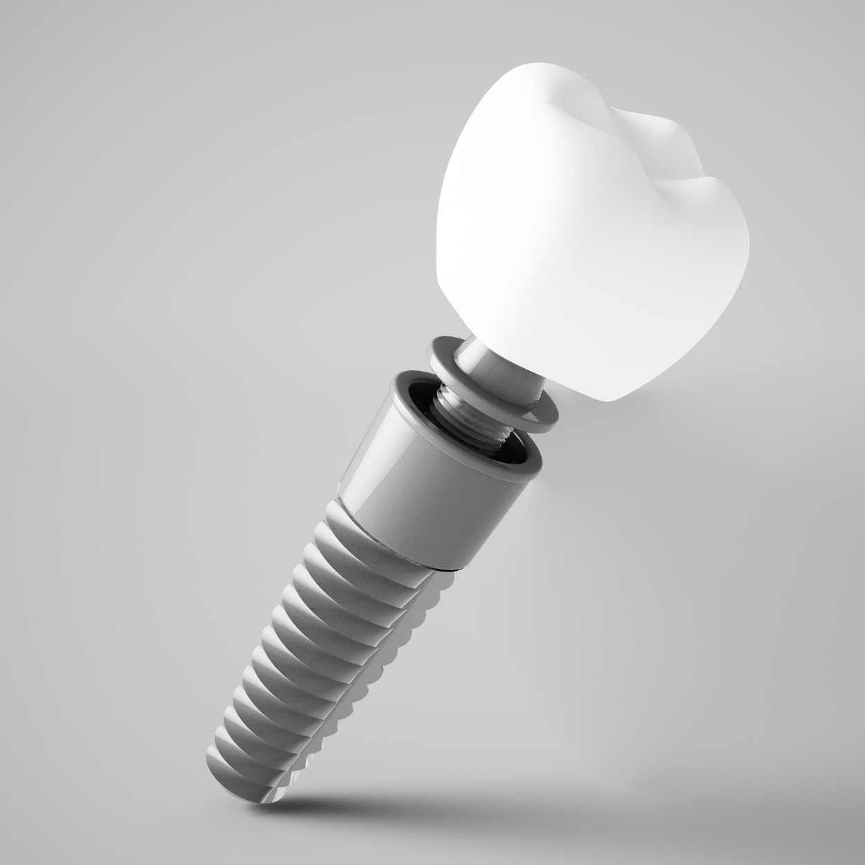 Implantes dentales con planificación digital
